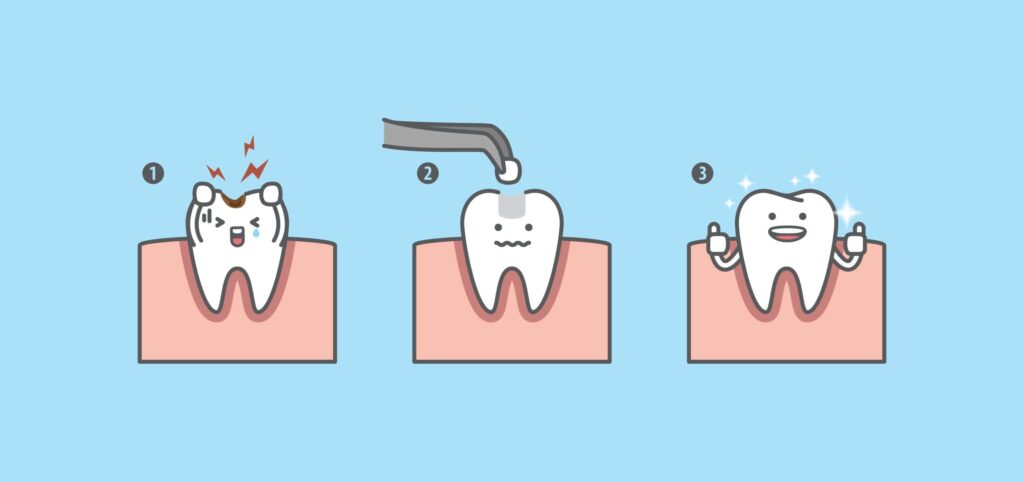 Fillings in San Jose