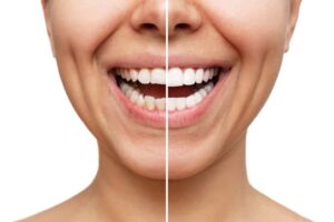 Porcelain Veneers in San Jose 