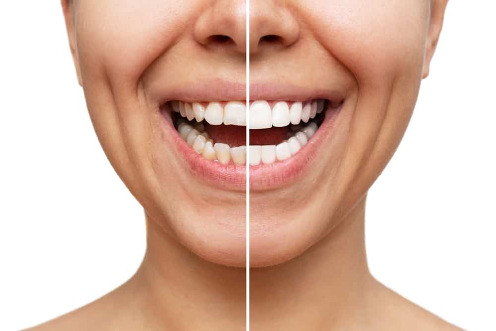 Porcelain Veneers in San Jose