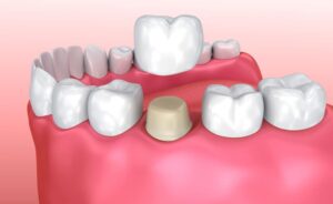 Dental Crowns in San Jose 