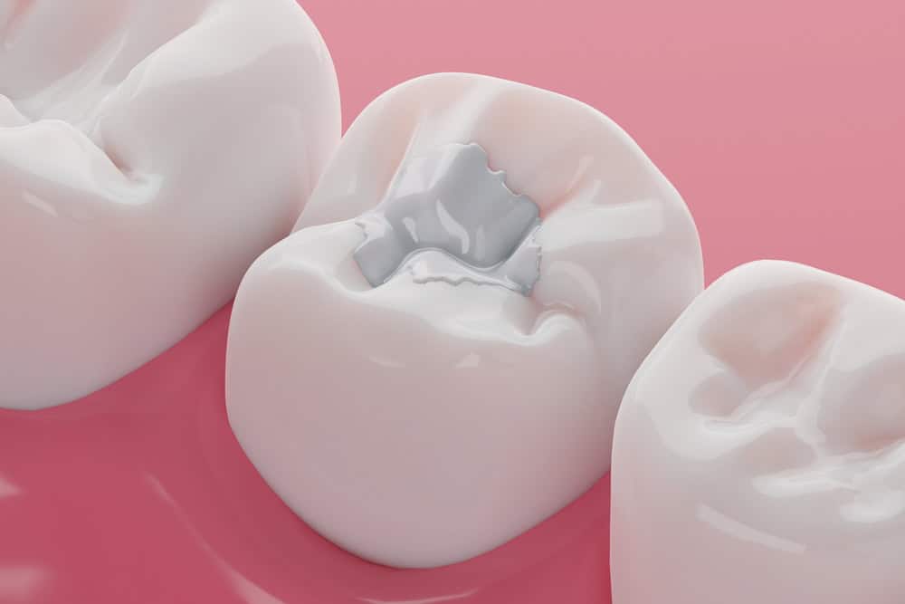 Illustration of a molar tooth cavity with a white filling