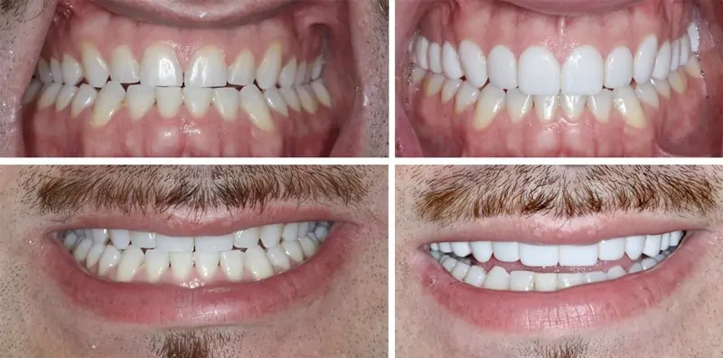 Before and After Image: Composite Veneers - front