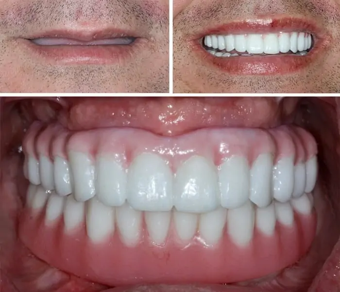 Before and After Image: Implant Supported Dentures - front