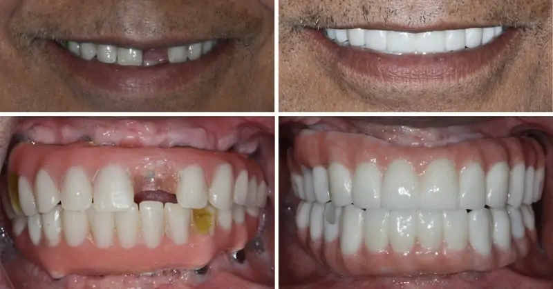 Before and After Image: Implant Supported Dentures - front