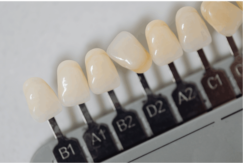Dental shade guide showing porcelain veneer color options for custom smile makeovers at Manassra Dental San Jose