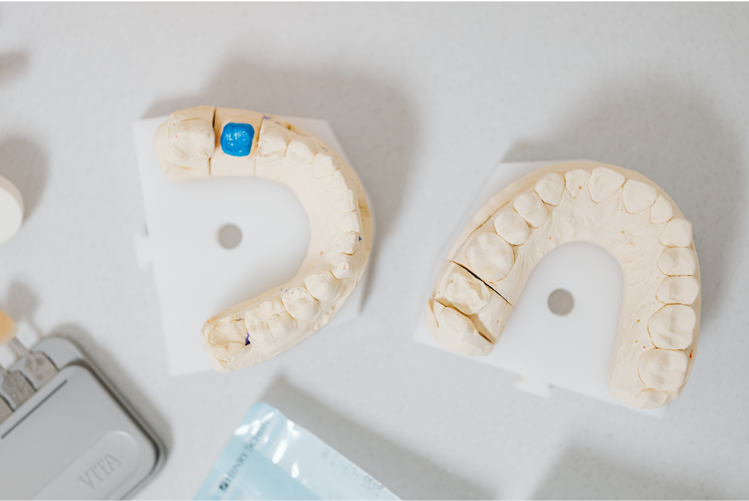 Dental arch models showing comprehensive full-mouth restoration treatment planning at Manassra Dental San Jose