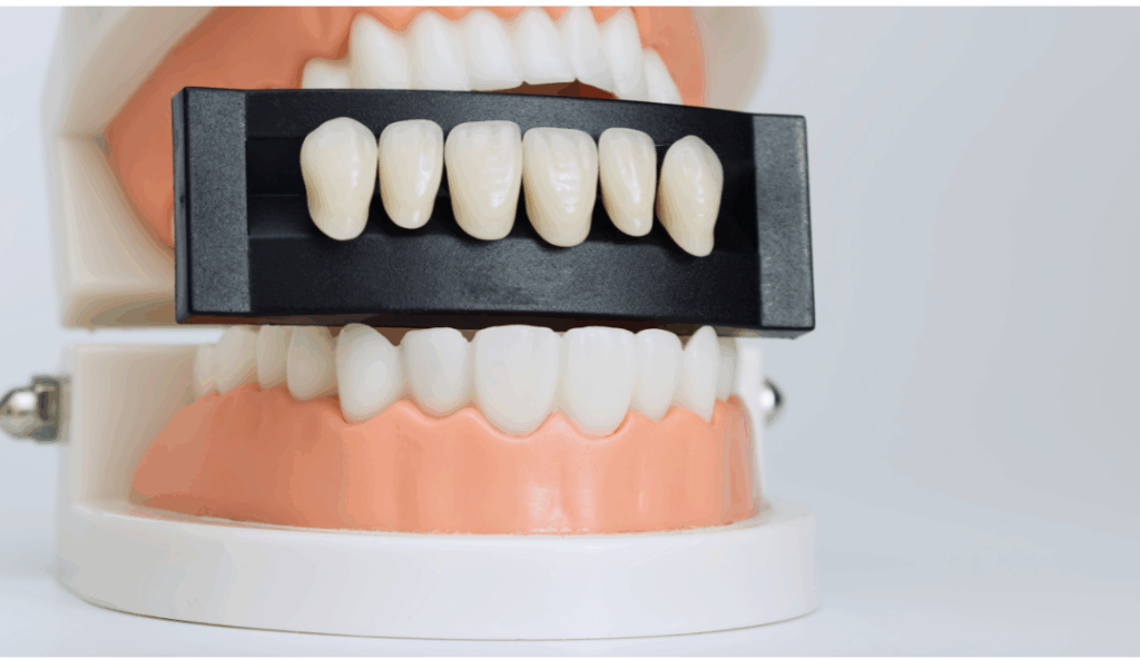 A dental model demonstrating porcelain veneer shade matching, used at Manassra Dental in San Jose to illustrate Jane’s porcelain veneers transformation.