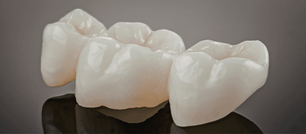 Close-up of a ceramic dental bridge used in restorative treatments at Manassra Dental in San Jose, showcasing high-quality craftsmanship and natural tooth aesthetics.