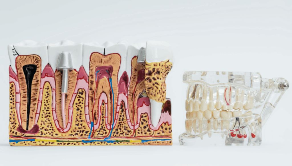 Detailed dental model showing internal tooth structure and a restorative device, representing the advanced design of **Dentures (Full and Partial)** and tooth replacement options at Manassra Dental in San Jose.
