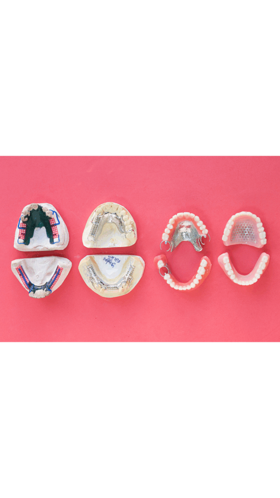 Collection of dental models and partial dentures showing metal frameworks and pink acrylic, illustrating the custom design for **Implant-Supported Dentures** and other prosthodontic solutions at Manassra Dental in San Jose.
