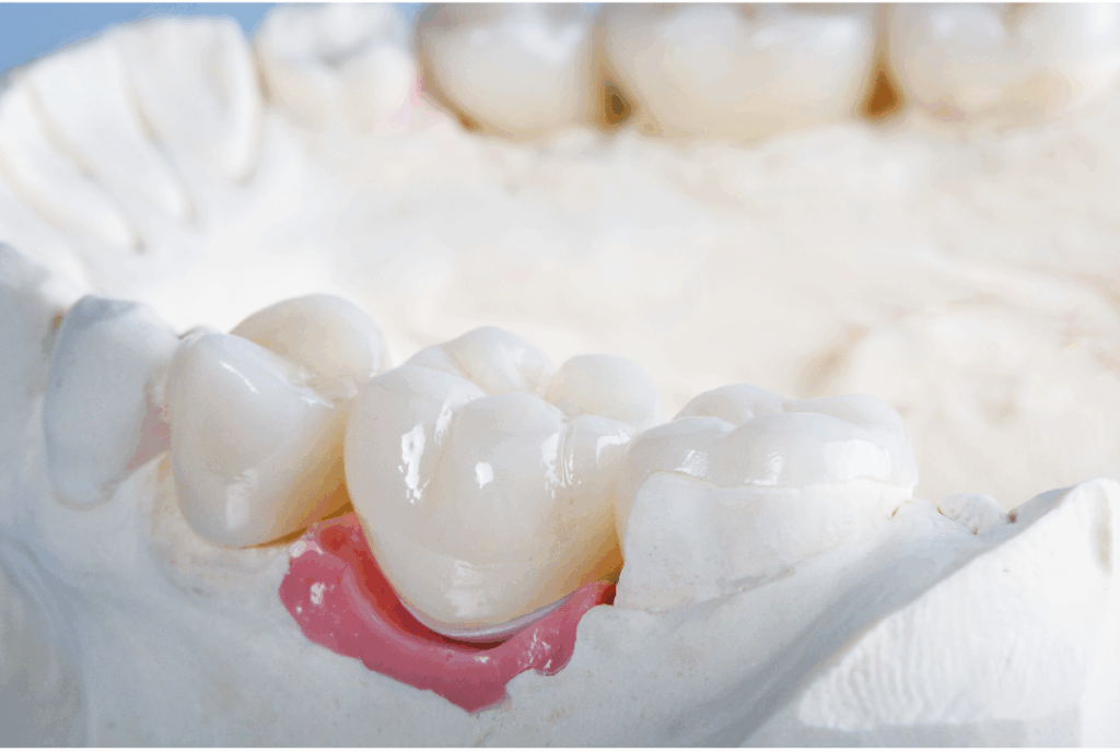 Close-up of highly aesthetic ceramic **Dental Crowns** seated on a dental model, demonstrating the **strength and beauty for damaged teeth** provided by Manassra Dental in San Jose.