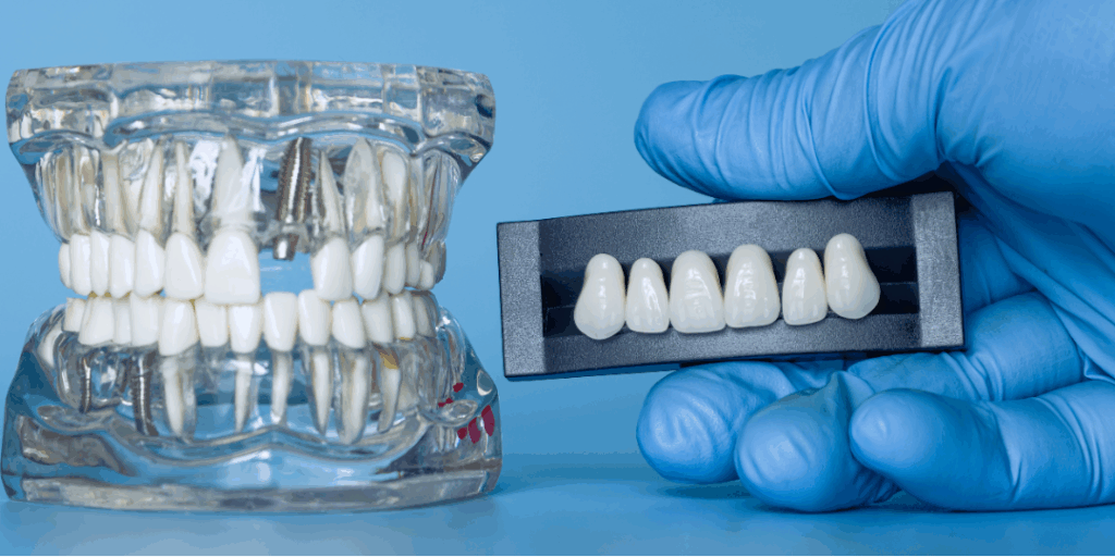Dental bridge model being carefully placed onto a prepared tooth structure using tweezers, illustrating **Dental Bridges** as a **reliable solution for missing teeth** at Manassra Dental in San Jose.