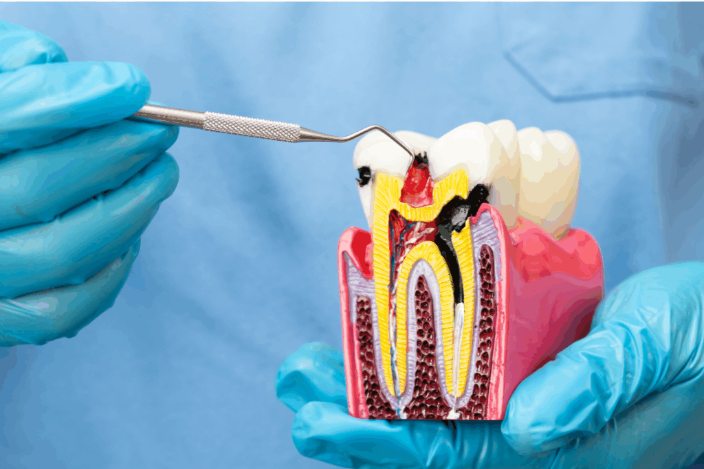 Dental professional pointing to an infected pulp in a cross-sectioned tooth model, illustrating the necessity of **Root Canal Therapy** for **saving infected teeth** at Manassra Dental in San Jose.