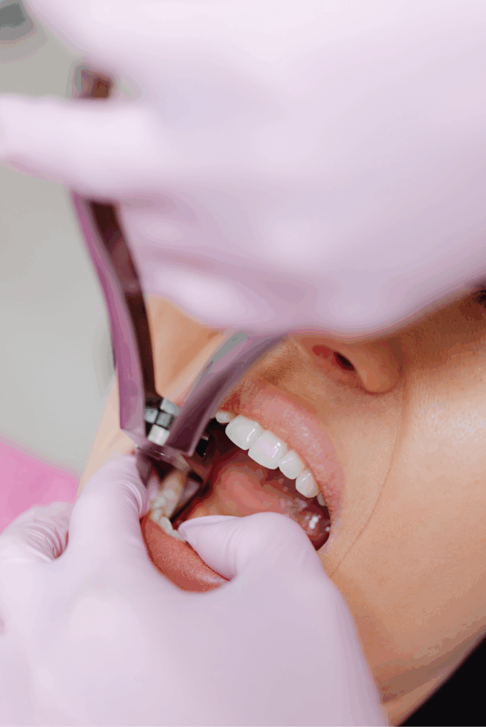 Dental professional performing a **tooth extraction** with specialized instruments on a patient's molar, ensuring **safe and gentle removal** at Manassra Dental in San Jose.
