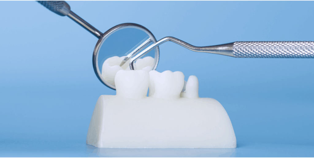Dentist showing a patient a model of a dental implant and crown, representing a consultation on the various **Tooth Replacement Options** available at Manassra Dental in San Jose.