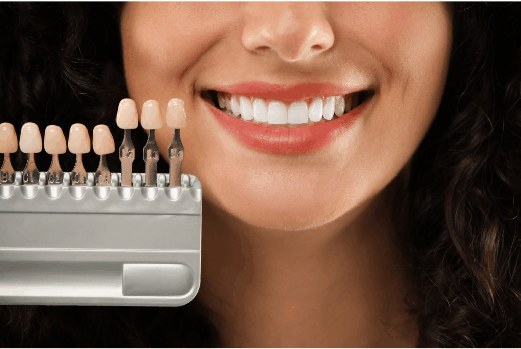 Cosmetic dentistry shade selection for matching dental veneers at Manassra Dental in San Jose.