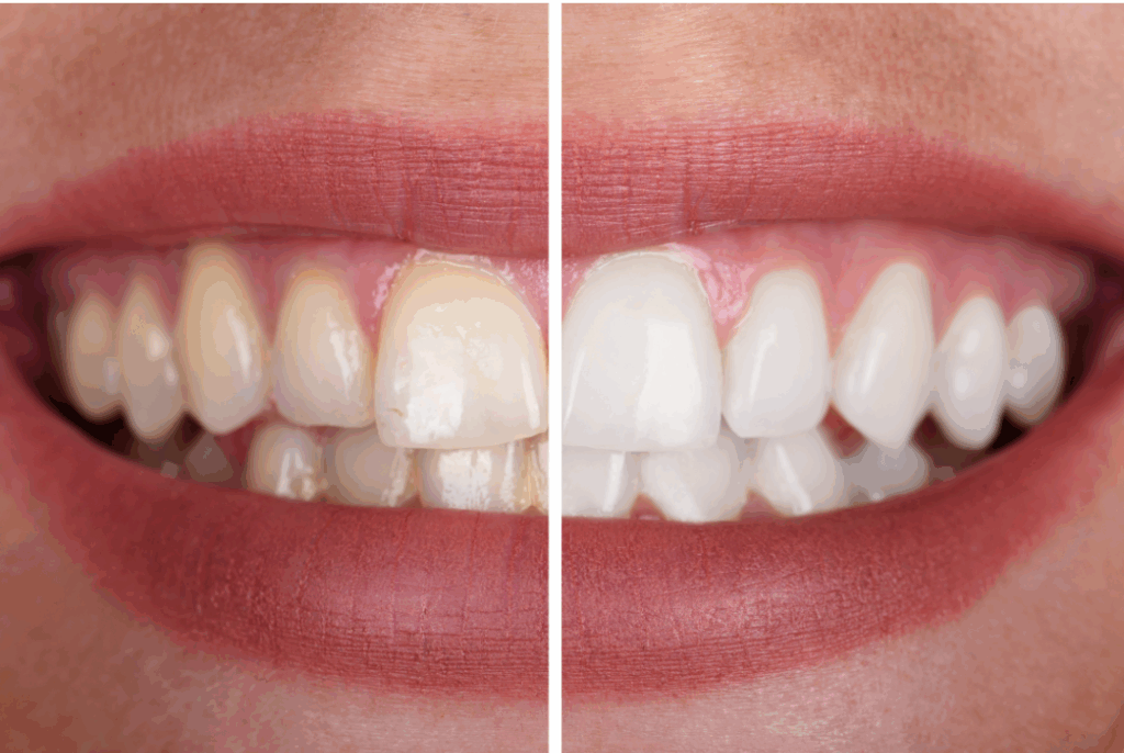 Before and after photo showing a dramatic transformation from stained, yellowed teeth (left) to a bright, white smile (right) achieved by professional **teeth whitening** at Manassra Dental in San Jose.