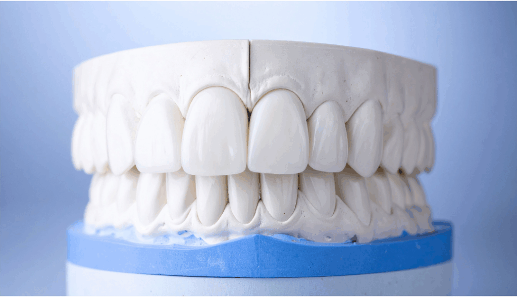 Close-up of a plaster dental model showing flawless, custom-designed porcelain veneers and crowns, representing premium **veneer dentistry** at Manassra Dental in San Jose.