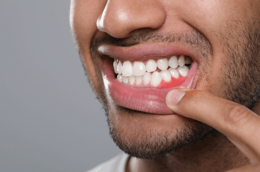 Close-up of a patient pointing to severely inflamed gum tissue, indicating a dental abscess requiring immediate **abscess drainage** at Manassra Dental in San Jose.