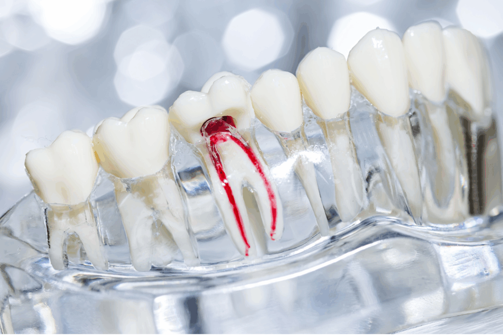 Dental model showing deep infection and inflamed nerve (red area) inside the tooth root, illustrating the need for **root canal treatment** at Manassra Dental in San Jose.