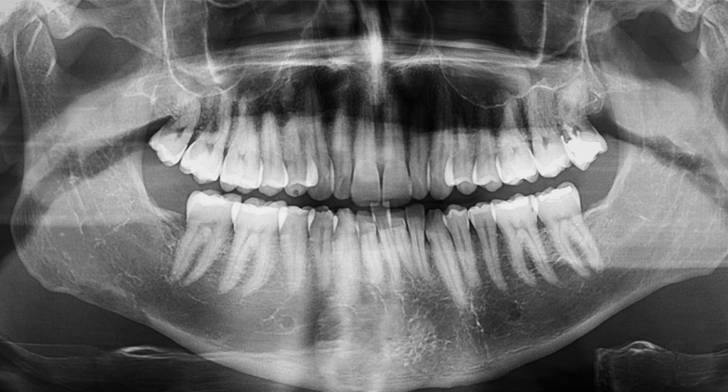 Full digital panoramic dental X-ray showing the entire upper and lower jaw, demonstrating **advanced imaging** for precise diagnosis at Manassra Dental in San Jose.
