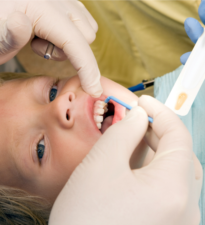 A dental professional applying fluoride varnish to a young patient's teeth at Manassra Dental.