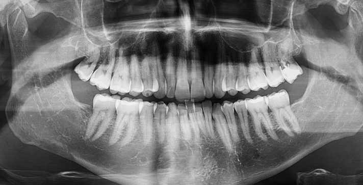 A full-mouth panoramic digital dental x-ray showing the complete jaw structure and teeth alignment at Manassra Dental.