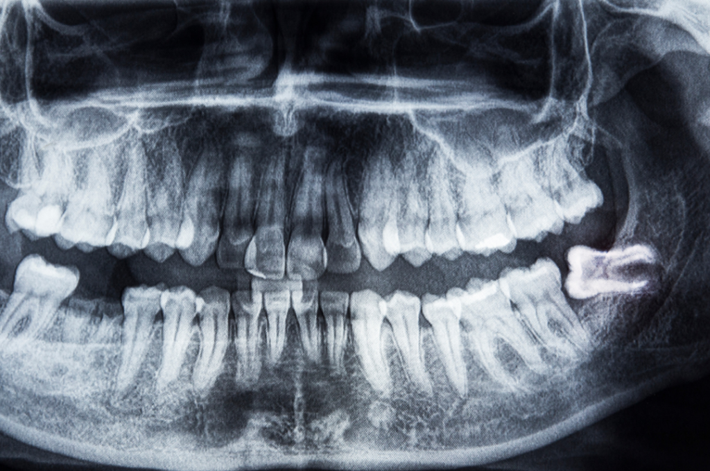 Digital dental X-ray showing an impacted wisdom tooth pushing against neighboring molars at Manassra Dental.