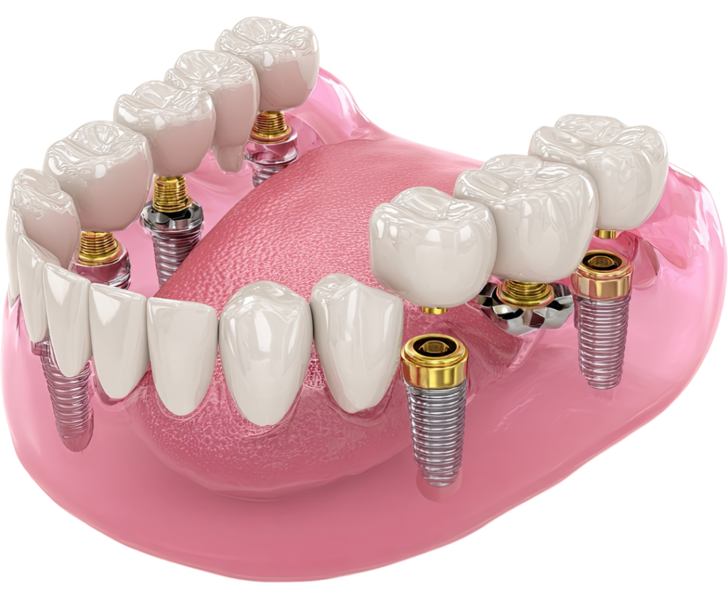 A 3D anatomical model showing a full lower arch of teeth supported by four strategically placed dental implants.