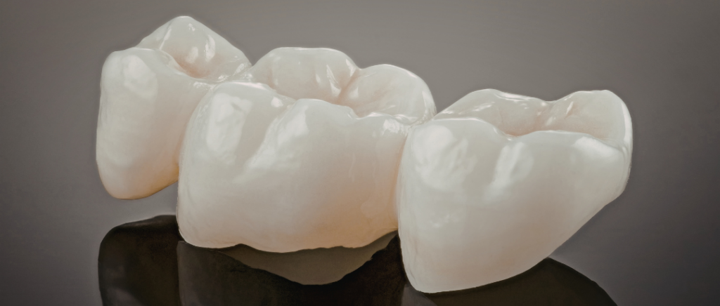 A high-quality three-unit porcelain dental bridge on a dark reflective surface.