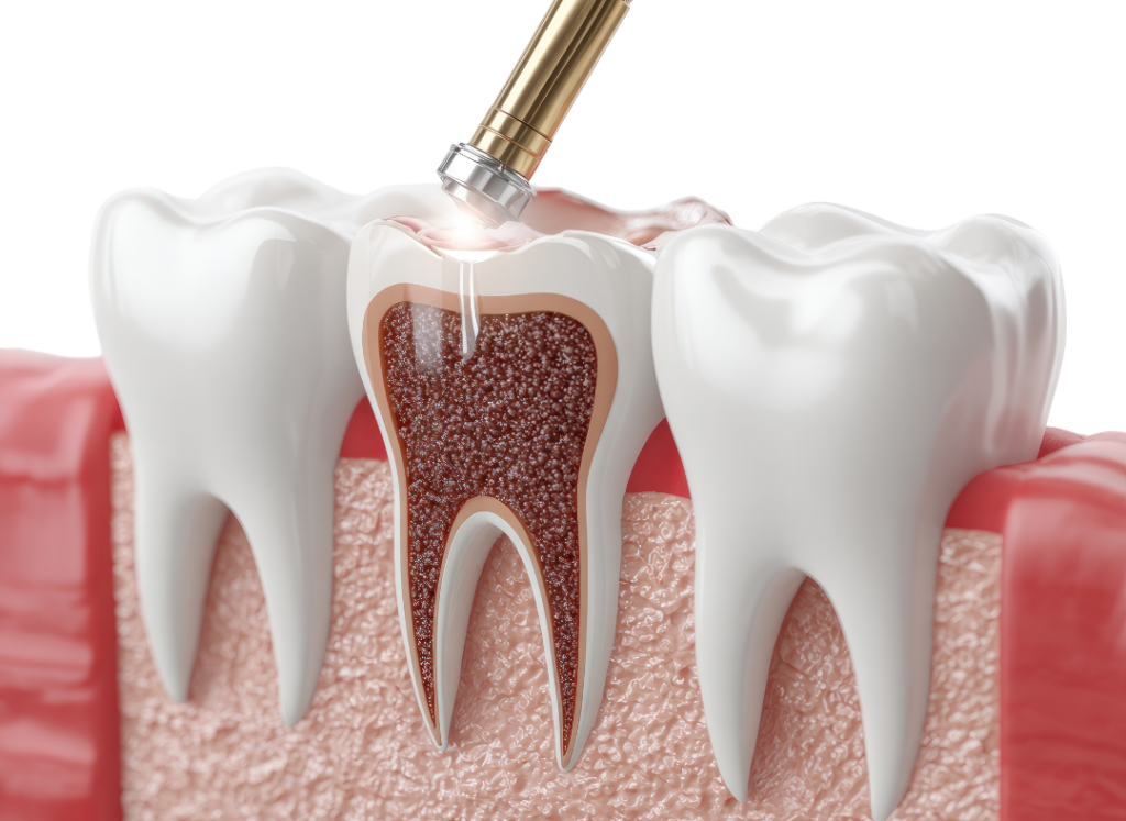 Application A 3D medical illustration of a dental tool applying a tooth-colored composite filling to a cross-section of a molar.