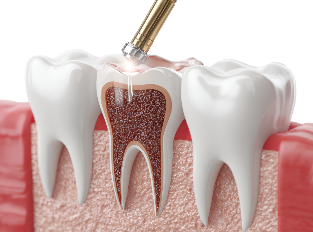 A digital 3D cross-section showing a dental instrument applying a protective sealant to the deep grooves of a molar.