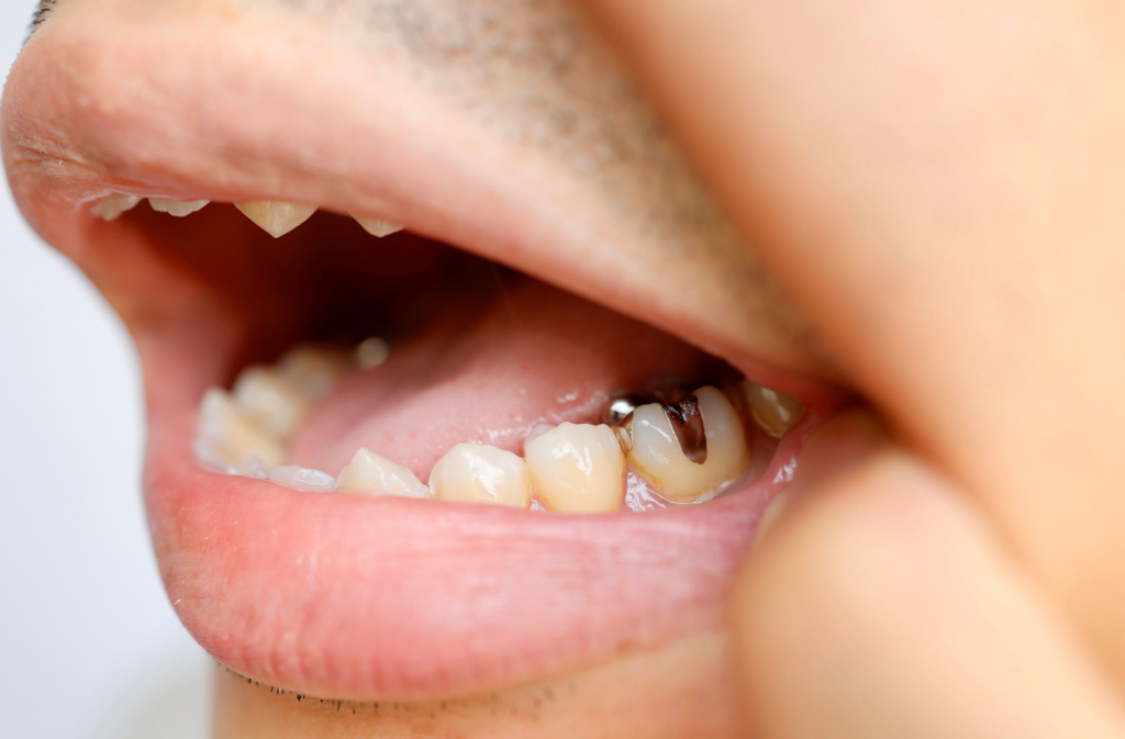 A close-up of a man pulling down his lip to show a tooth needing an inlay or onlay.