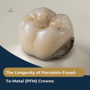 Close-up of an isolated porcelain-fused-to-metal (PFM) dental crown on a neutral background, showing the tooth-colored porcelain outer shell and exposed metal alloy base.